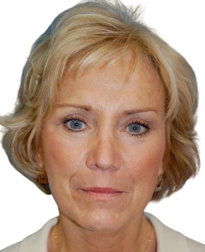 Deep Plane Facelift Before & After Gallery - Patient 13948528 - Image 2