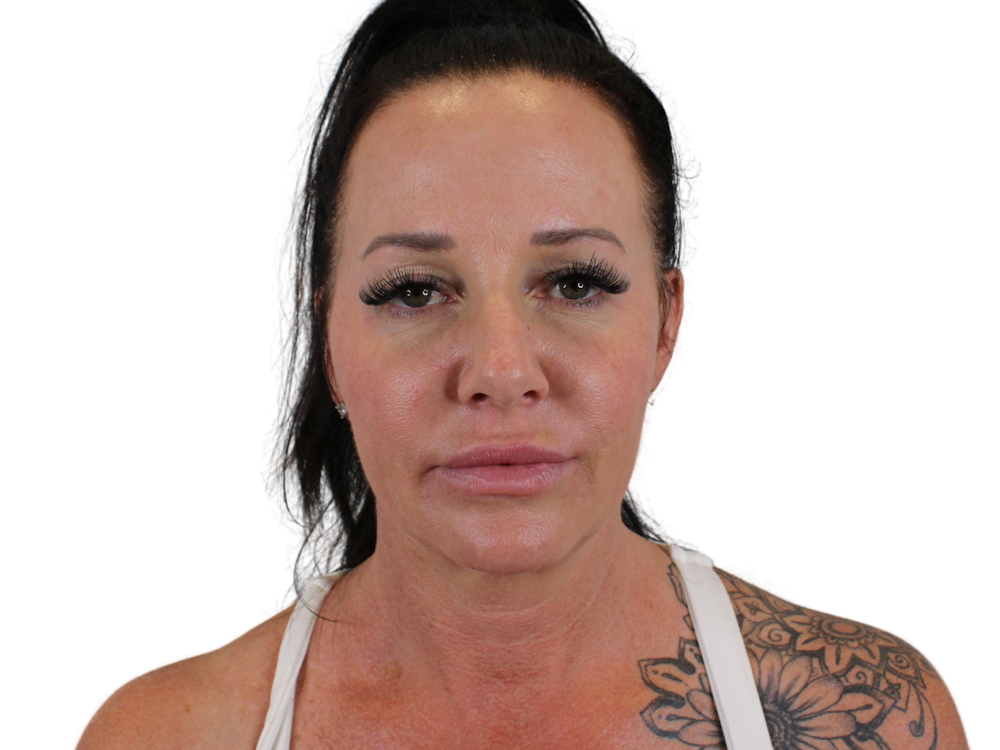 Deep Neck Lift Before & After Gallery - Patient 122751157 - Image 1
