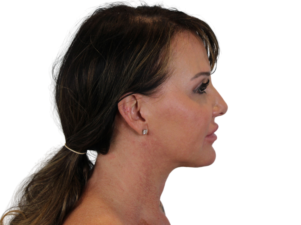 Neck Lift Before & After Gallery - Patient 122751157 - Image 6