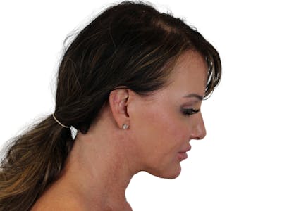 Deep Neck Lift Before & After Gallery - Patient 122751157 - Image 8