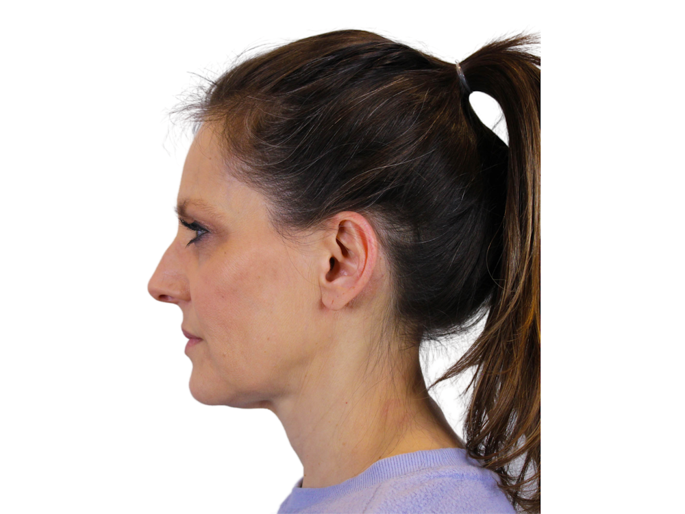 Deep Plane Facelift Before & After Gallery - Patient 122751206 - Image 7
