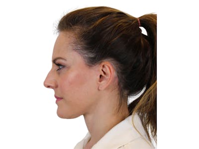 Deep Neck Lift Before & After Gallery - Patient 122751194 - Image 8