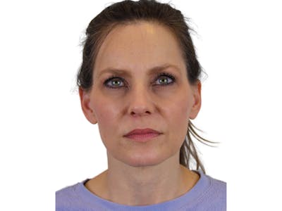 Facelift Before & After Gallery - Patient 122751206 - Image 1
