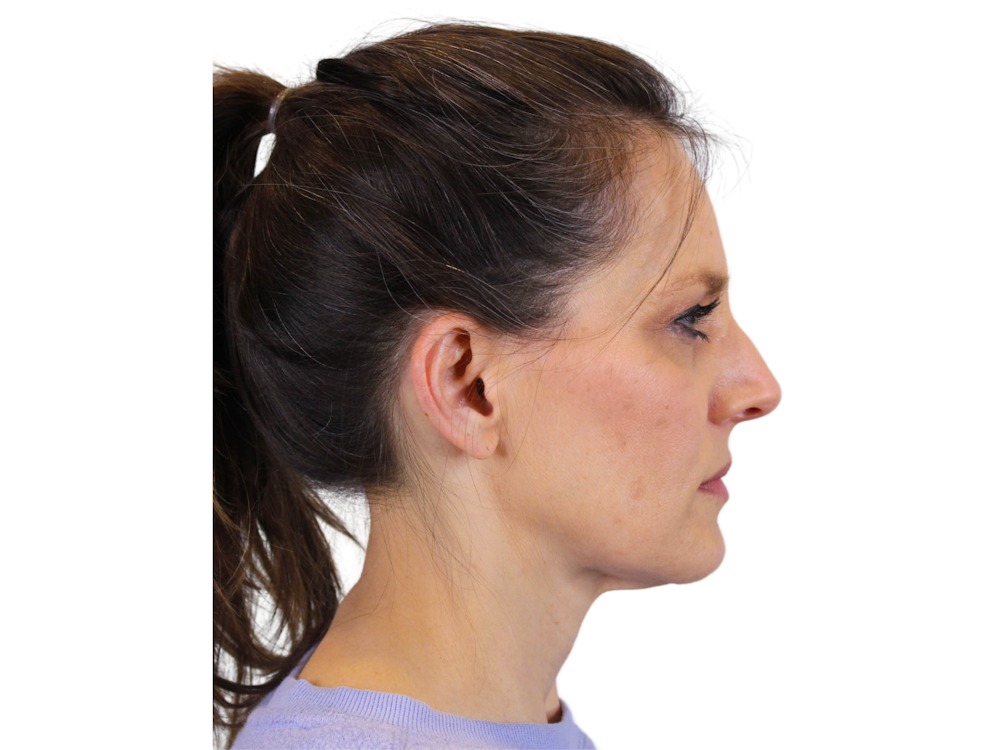 Facelift Before & After Gallery - Patient 122751206 - Image 3