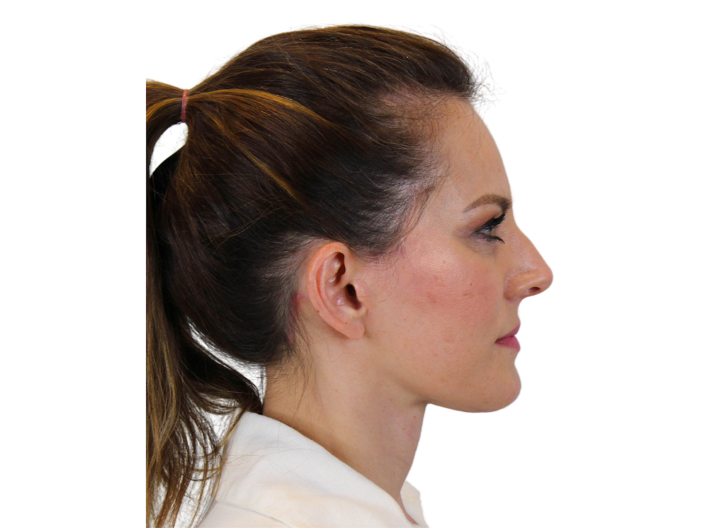 Deep Neck Lift Before & After Gallery - Patient 122751194 - Image 4