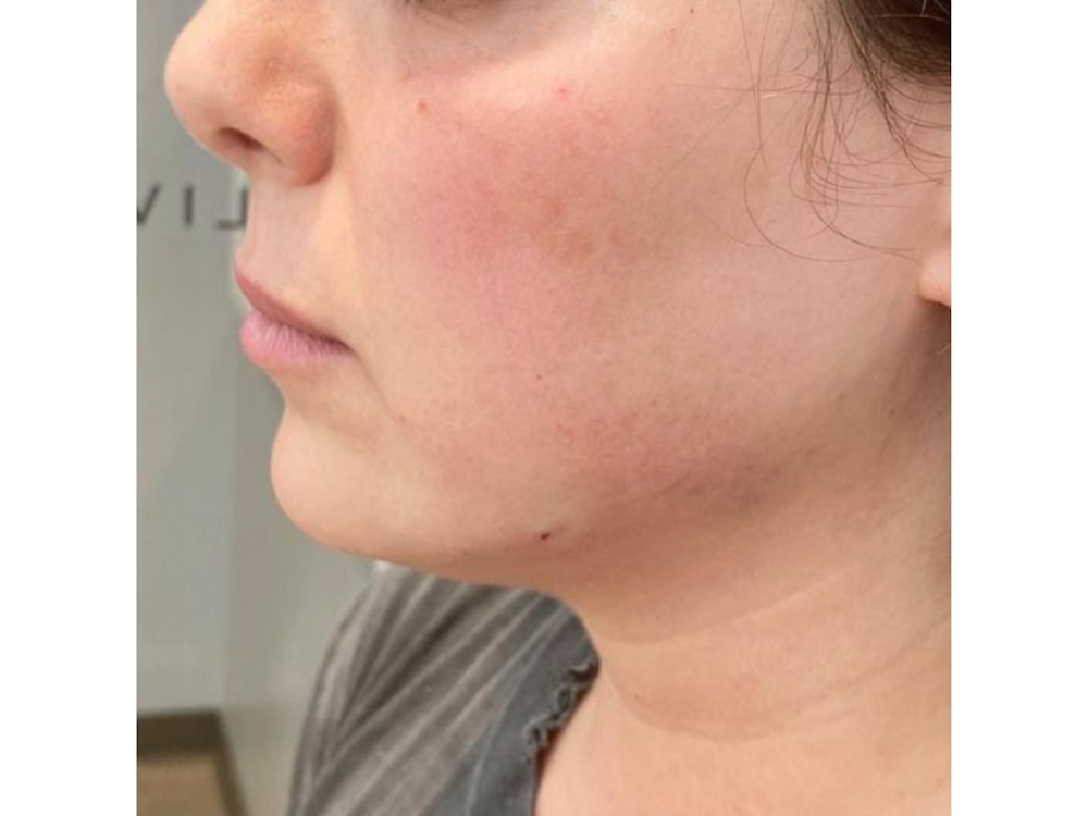 Chin Filler Before & After Gallery - Patient 122931952 - Image 2