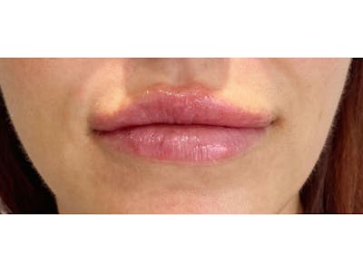 Lip Filler Before & After Gallery - Patient 122931988 - Image 2