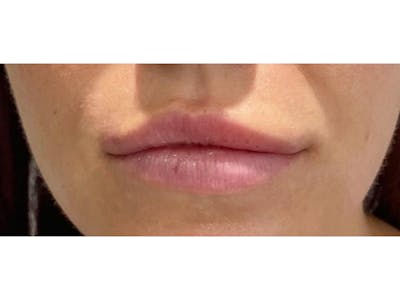 Lip Filler Before & After Gallery - Patient 122931988 - Image 1