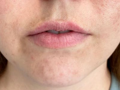 Lip Filler Before & After Gallery - Patient 122932023 - Image 1