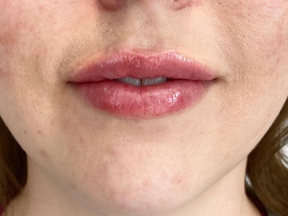 Lip Filler Before & After Gallery - Patient 122932023 - Image 2
