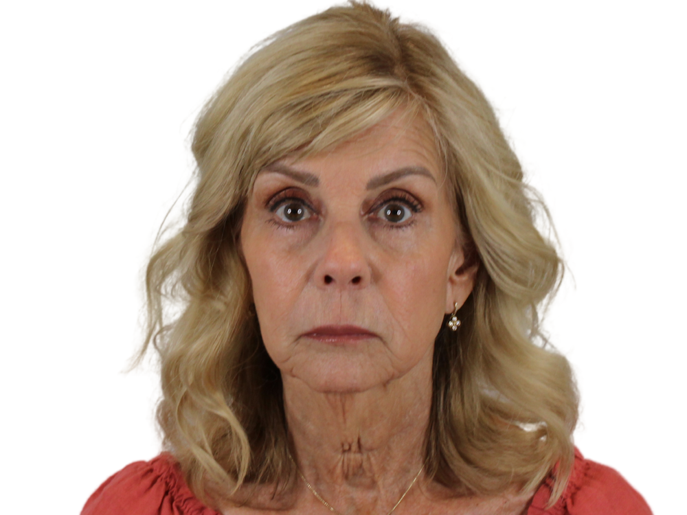 Sculptra Before & After Gallery - Patient 122932040 - Image 2