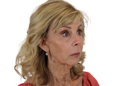 Sculptra Before & After Gallery - Patient 122932040 - Image 4