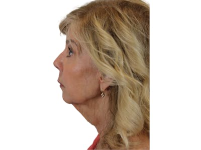 Sculptra Before & After Gallery - Patient 122932040 - Image 8