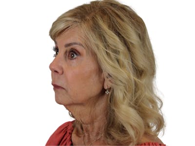 Sculptra Before & After Gallery - Patient 122932040 - Image 6