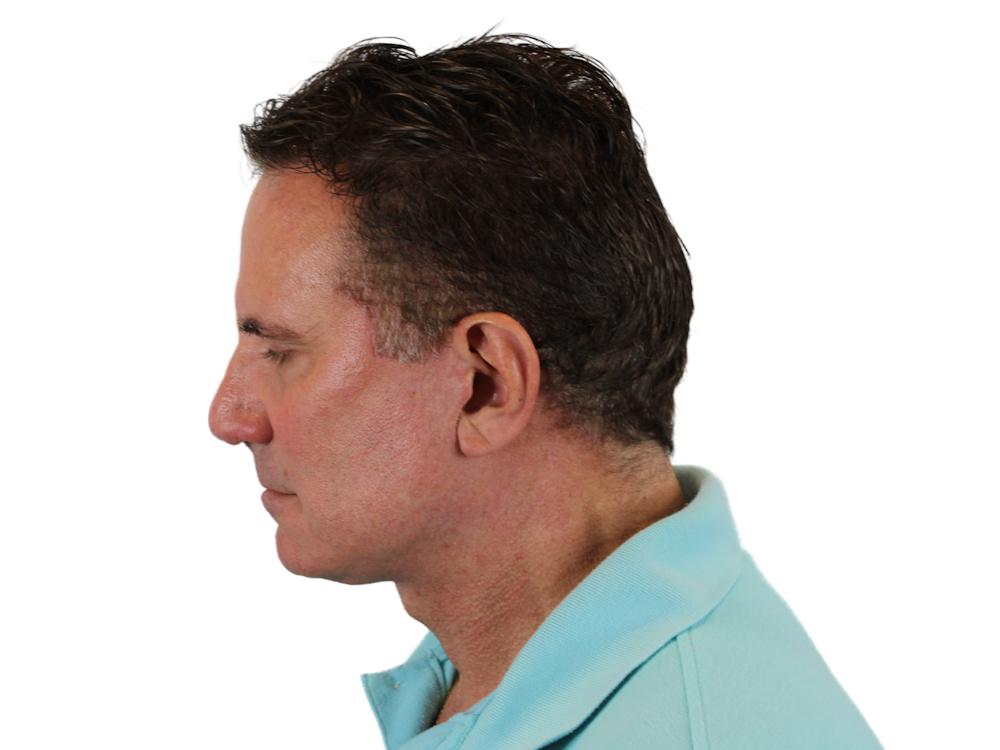 Deep Neck Lift Before & After Gallery - Patient 131840908 - Image 8