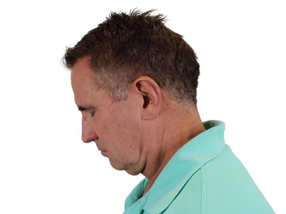 Neck Lift Before & After Gallery - Patient 131840908 - Image 7