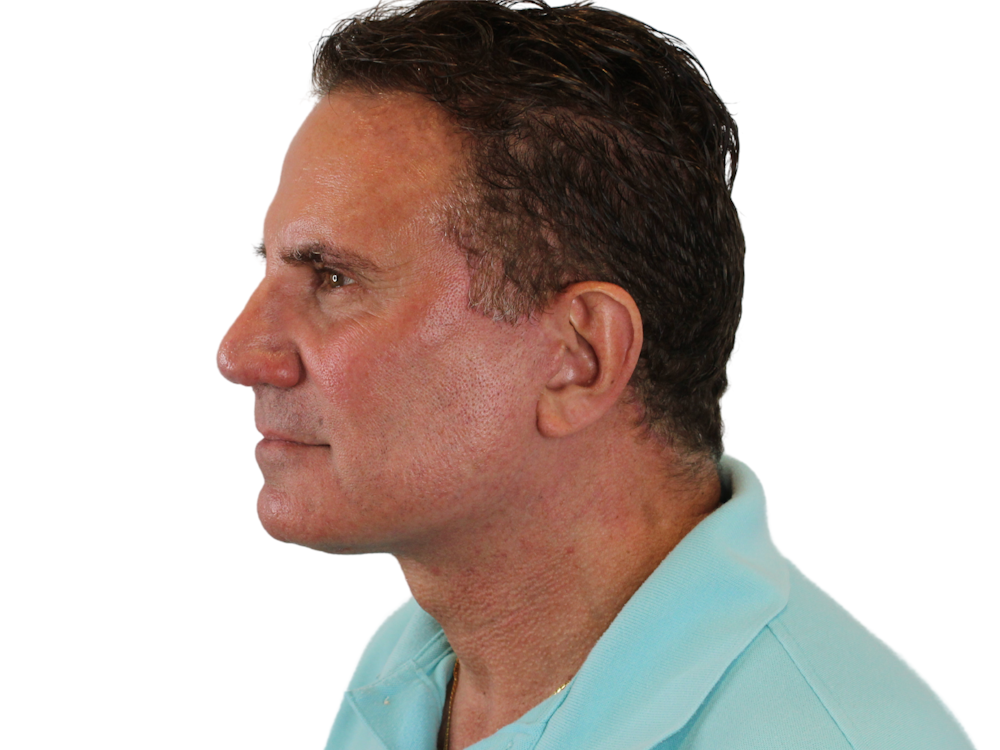 Deep Neck Lift Before & After Gallery - Patient 131840908 - Image 4