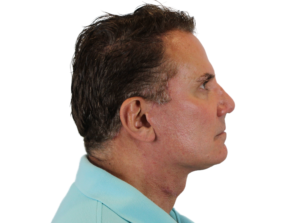 Deep Neck Lift Before & After Gallery - Patient 131840908 - Image 12
