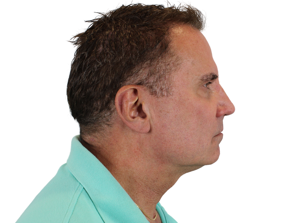 Neck Lift Before & After Gallery - Patient 131840908 - Image 11