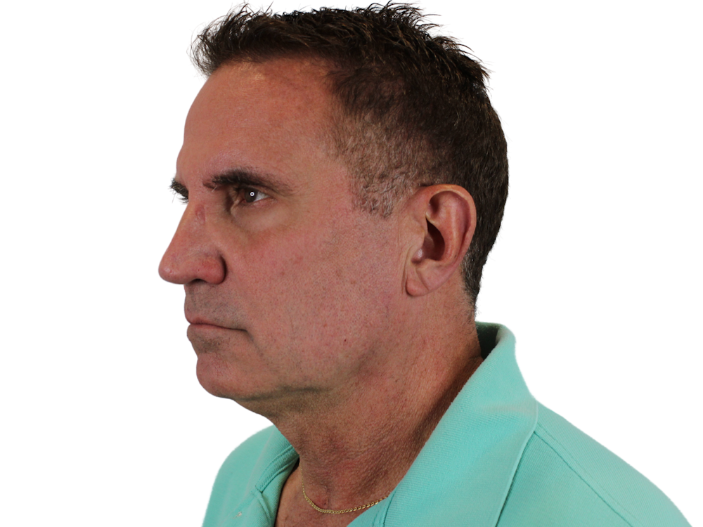 Deep Neck Lift Before & After Gallery - Patient 131840908 - Image 3