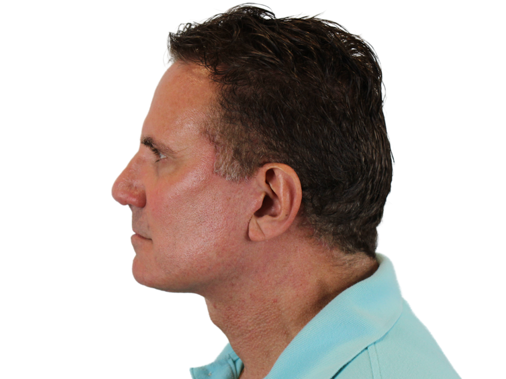 Neck Lift Before & After Gallery - Patient 131840908 - Image 6