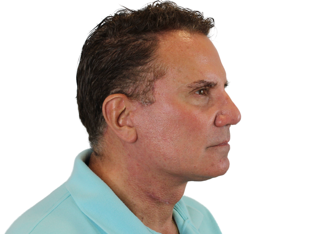 Neck Lift Before & After Gallery - Patient 131840908 - Image 10