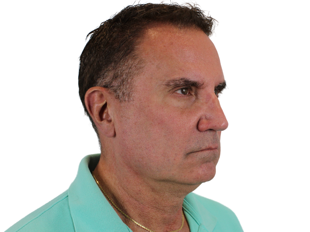 Neck Lift Before & After Gallery - Patient 131840908 - Image 9