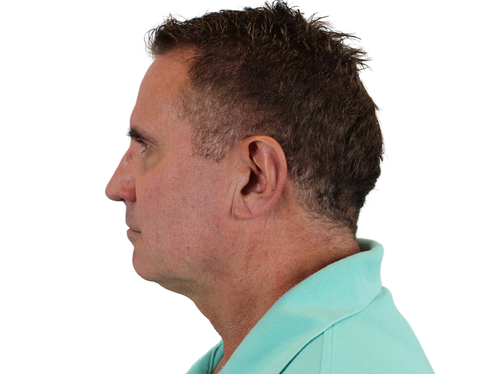 Deep Neck Lift Before & After Gallery - Patient 131840908 - Image 5