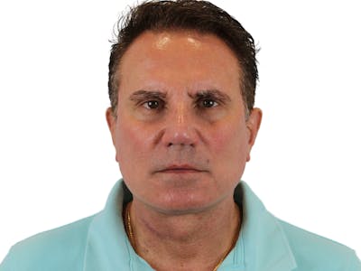 Deep Neck Lift Before & After Gallery - Patient 131840908 - Image 2