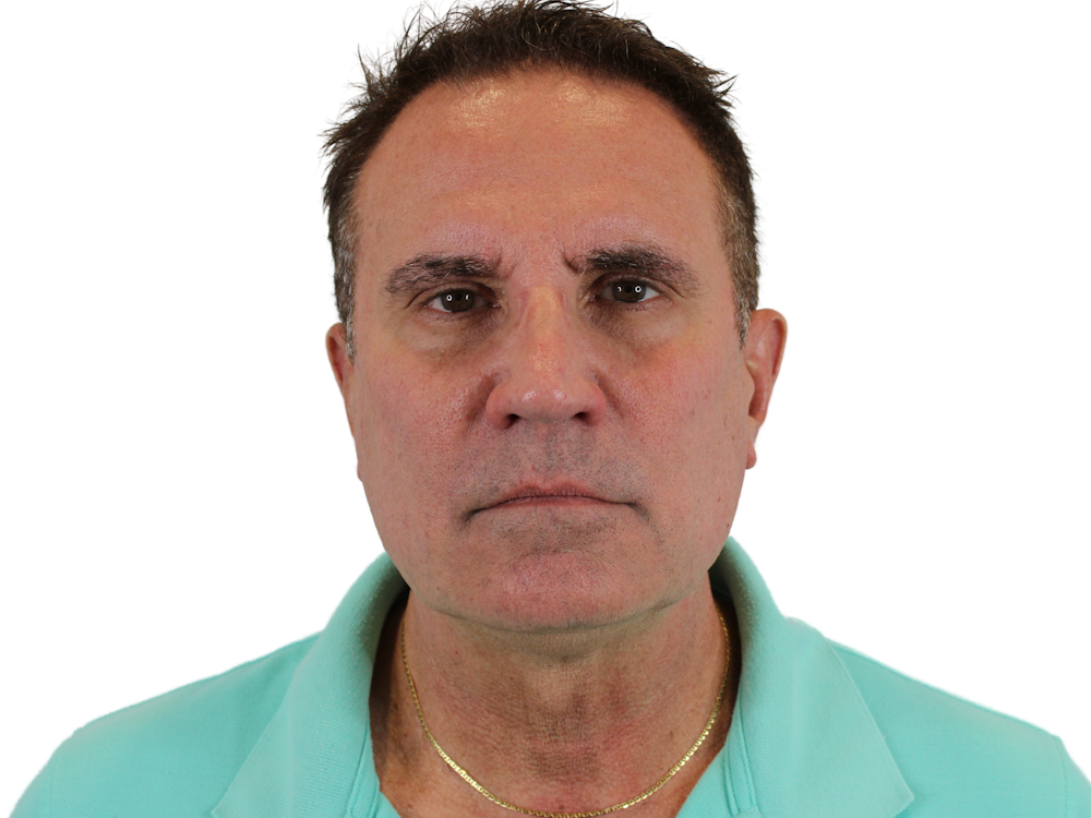 Deep Neck Lift Before & After Gallery - Patient 131840908 - Image 1