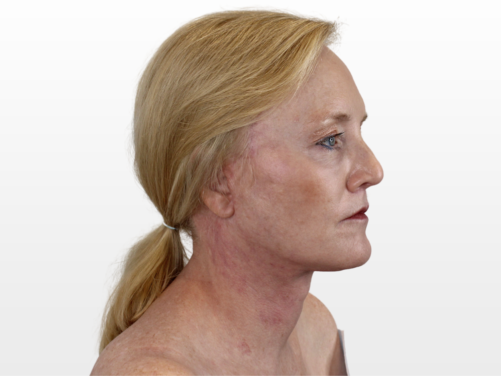 Deep Plane Facelift Before & After Gallery - Patient 131472422 - Image 4