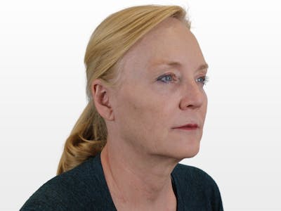 Deep Neck Lift Before & After Gallery - Patient 131840909 - Image 1