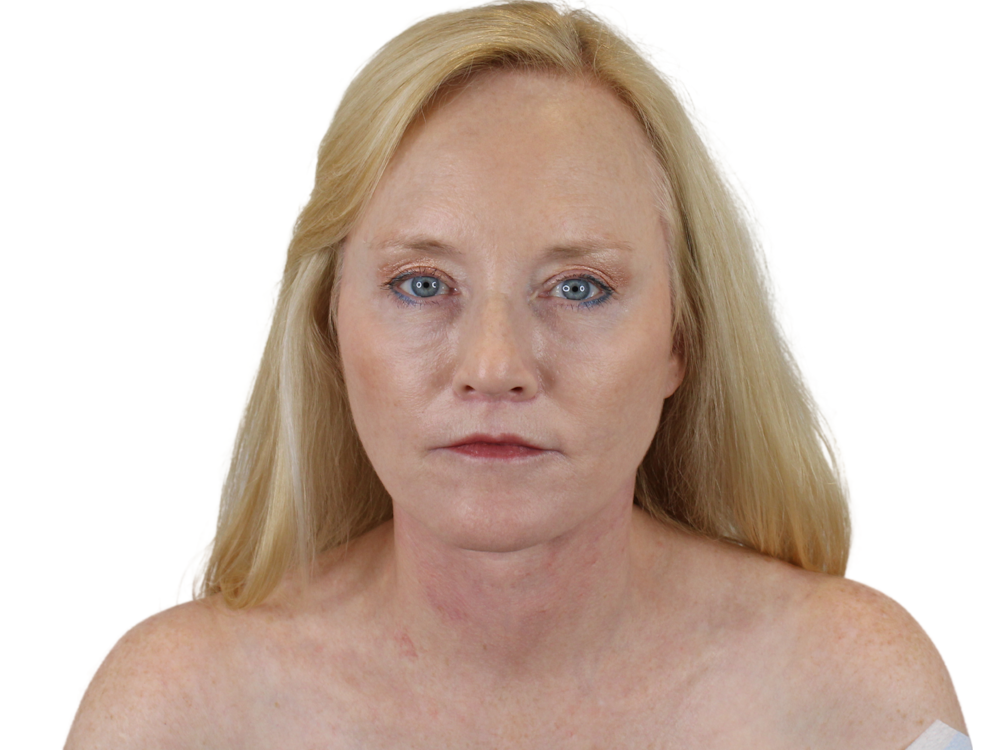 Deep Plane Facelift Before & After Gallery - Patient 131472422 - Image 2