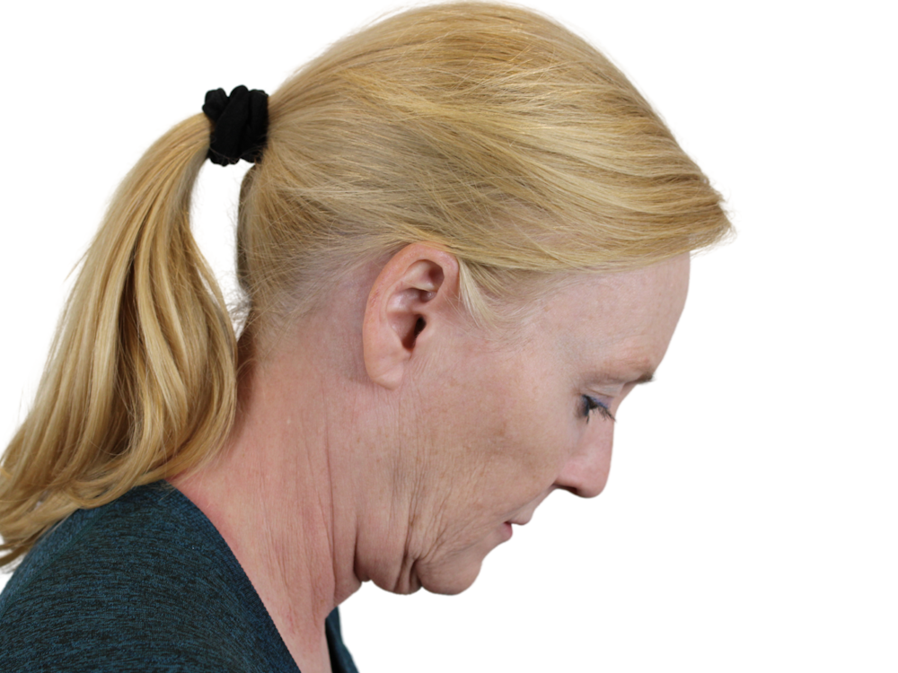 Deep Neck Lift Before & After Gallery - Patient 131840909 - Image 5
