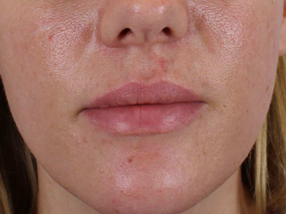 Lip Filler Before & After Gallery - Patient 140609987 - Image 1