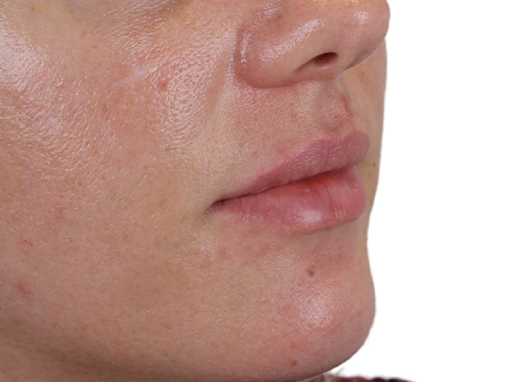 Lip Filler Before & After Gallery - Patient 140609987 - Image 3