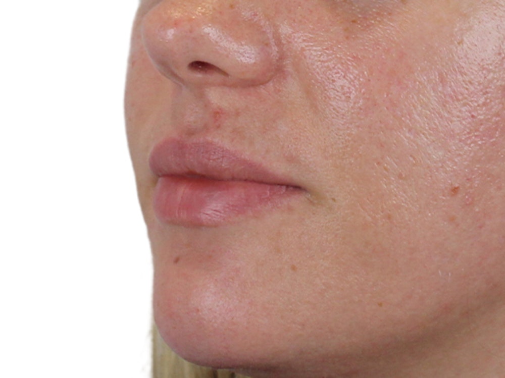 Lip Filler Before & After Gallery - Patient 140609987 - Image 5