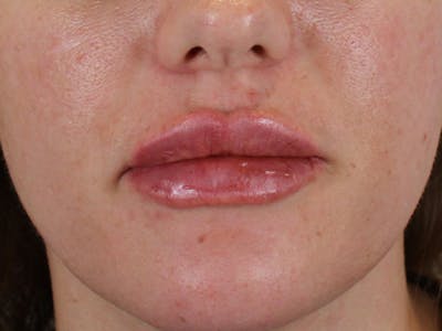 Lip Filler Before & After Gallery - Patient 140609987 - Image 2