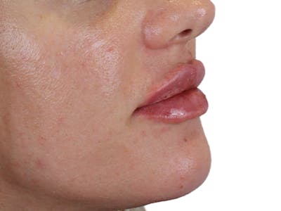 Lip Filler Before & After Gallery - Patient 140609987 - Image 4