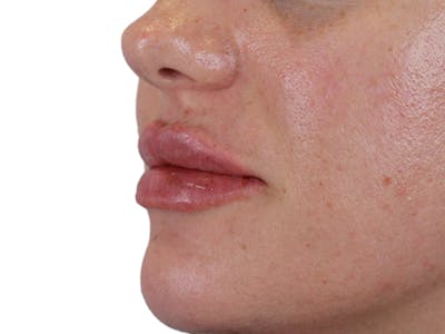 Lip Filler Before & After Gallery - Patient 140609987 - Image 6
