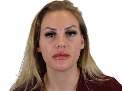 Lip Filler Before & After Gallery - Patient 140609987 - Image 8