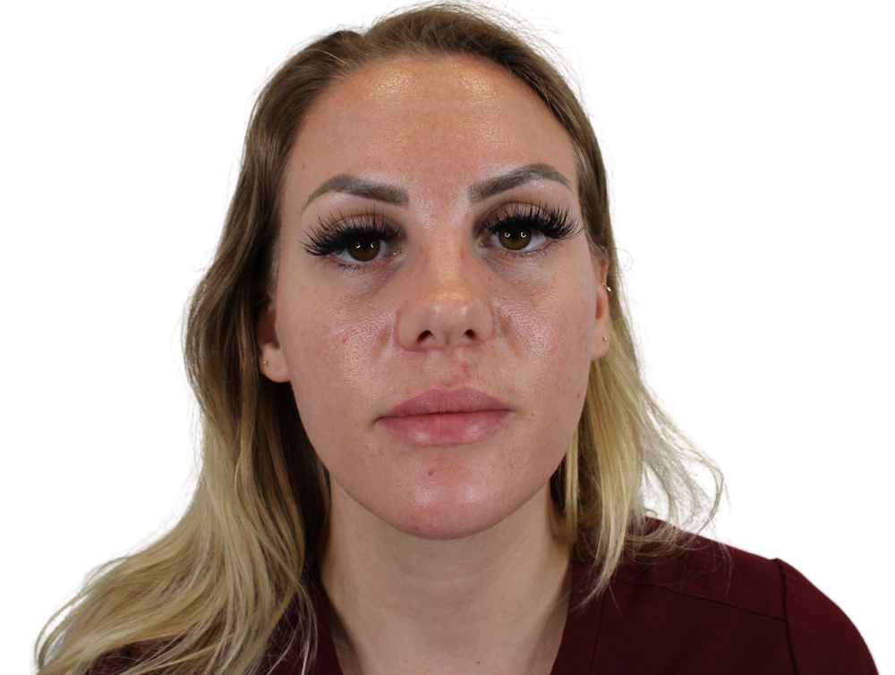 Lip Filler Before & After Gallery - Patient 140609987 - Image 7