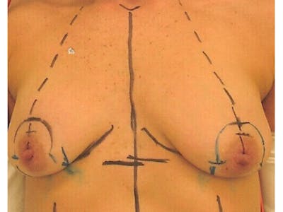 Breast Lift Before & After Gallery - Patient 141067129 - Image 1
