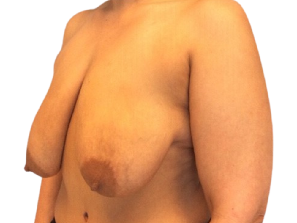 Breast Lift Before & After Gallery - Patient 141067128 - Image 3