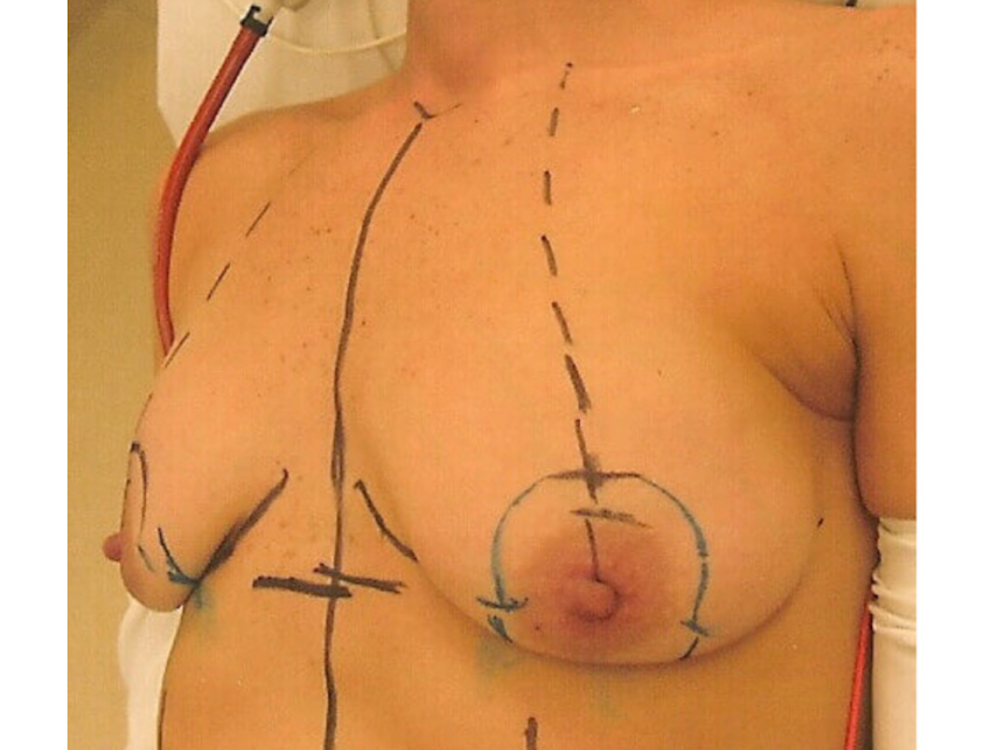 Breast Lift Before & After Gallery - Patient 141067129 - Image 3