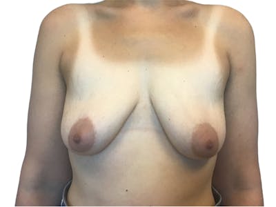 Breast Lift Before & After Gallery - Patient 141067126 - Image 1