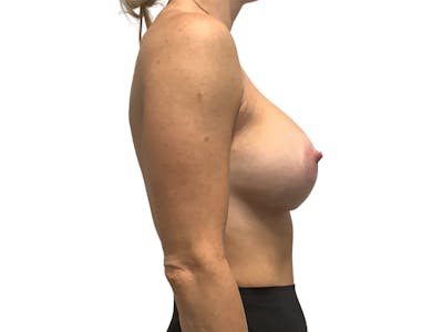 Breast Lift Gallery - Patient 141067125 - Image 6