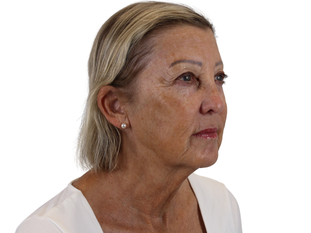 Deep Plane Facelift Before & After Gallery - Patient 141525494 - Image 3