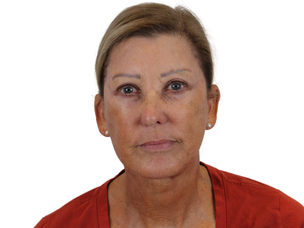 Facelift Before & After Gallery - Patient 141525494 - Image 2