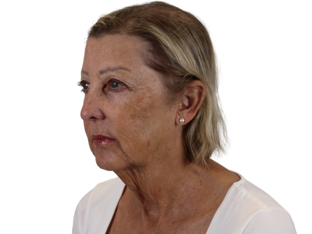 Deep Plane Facelift Before & After Gallery - Patient 141525494 - Image 5